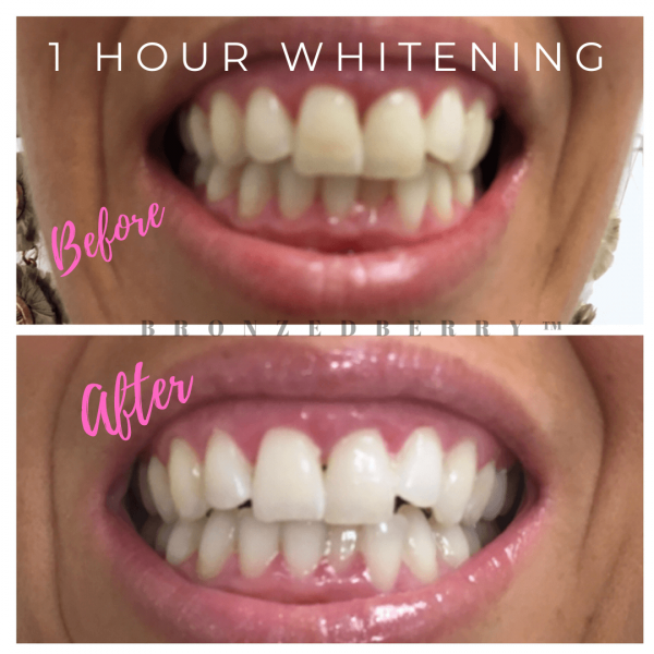 one hour teeth whitening before and after