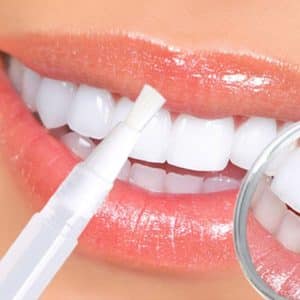 teeth whitening gel pen white smile